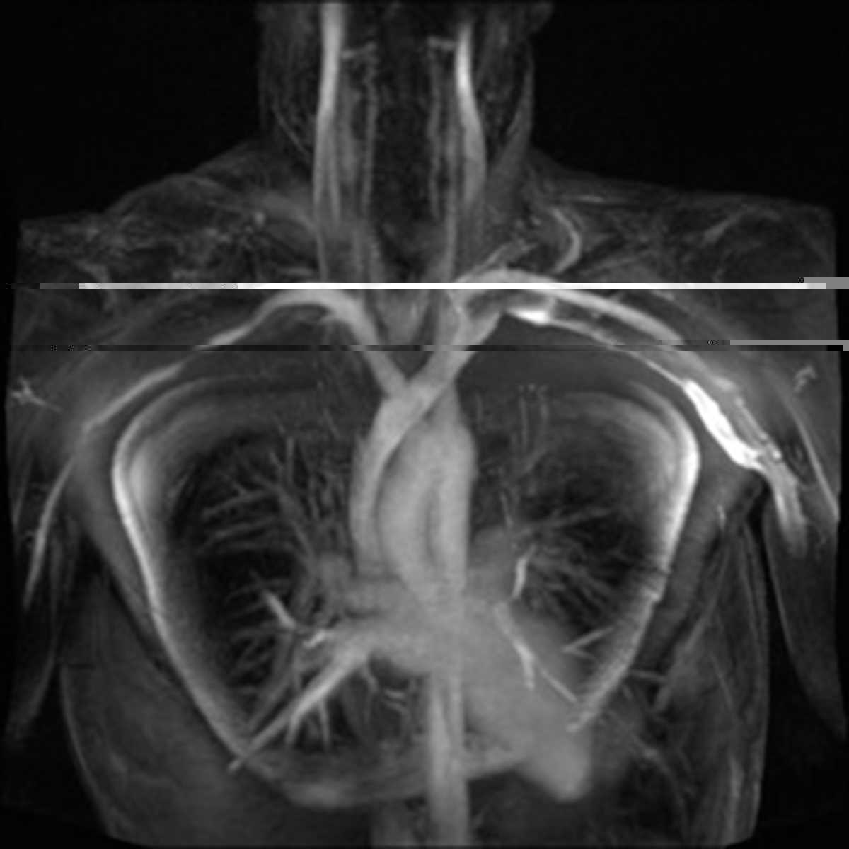 Thoracic outlet syndrome - CTisus CT Scan
