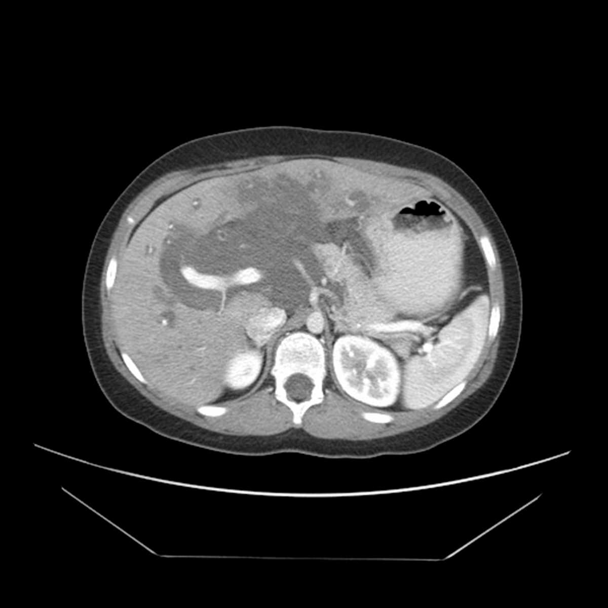Plexiform neurofibroma - CTisus CT Scan