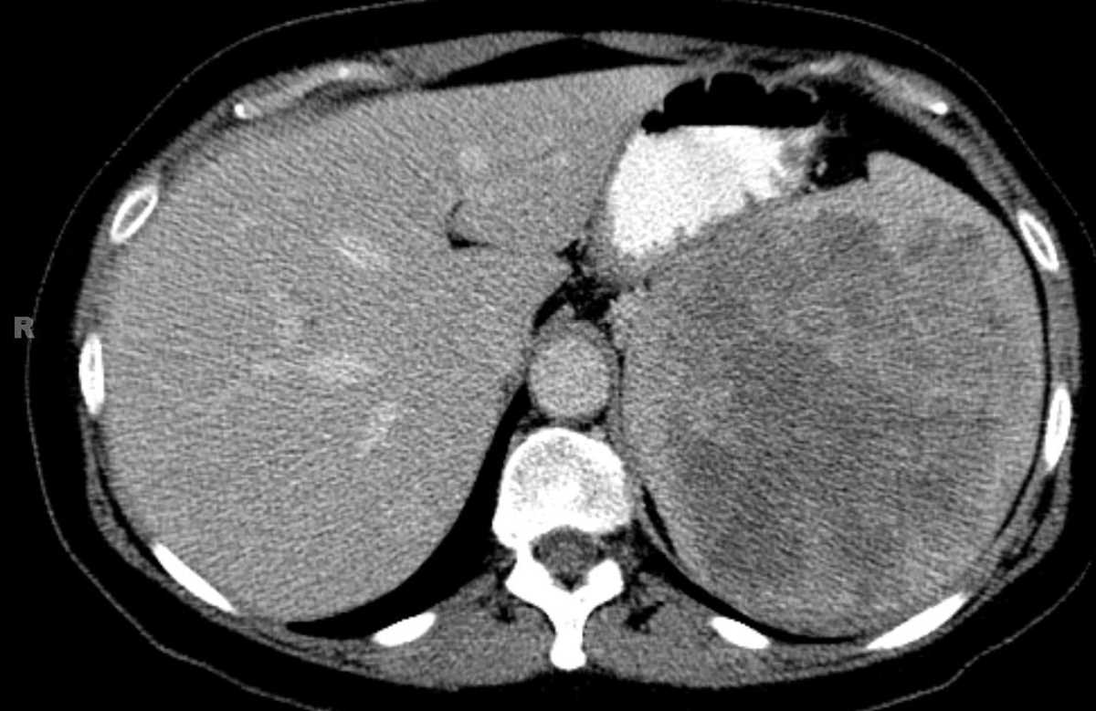 Splenic angiosarcoma - CTisus CT Scan