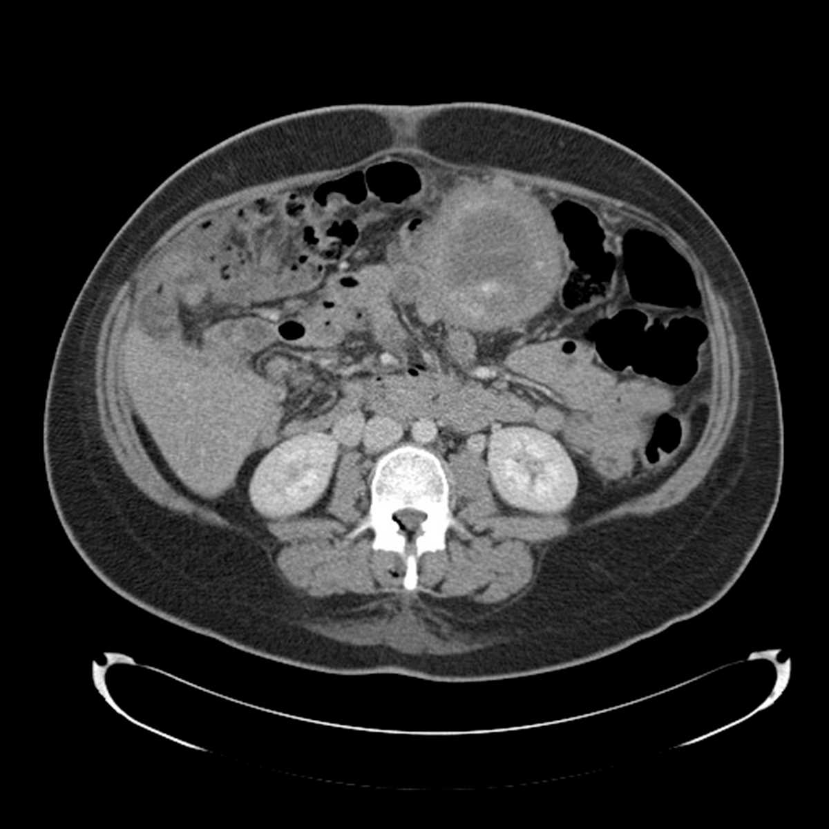 Gossypiboma - CTisus CT Scan