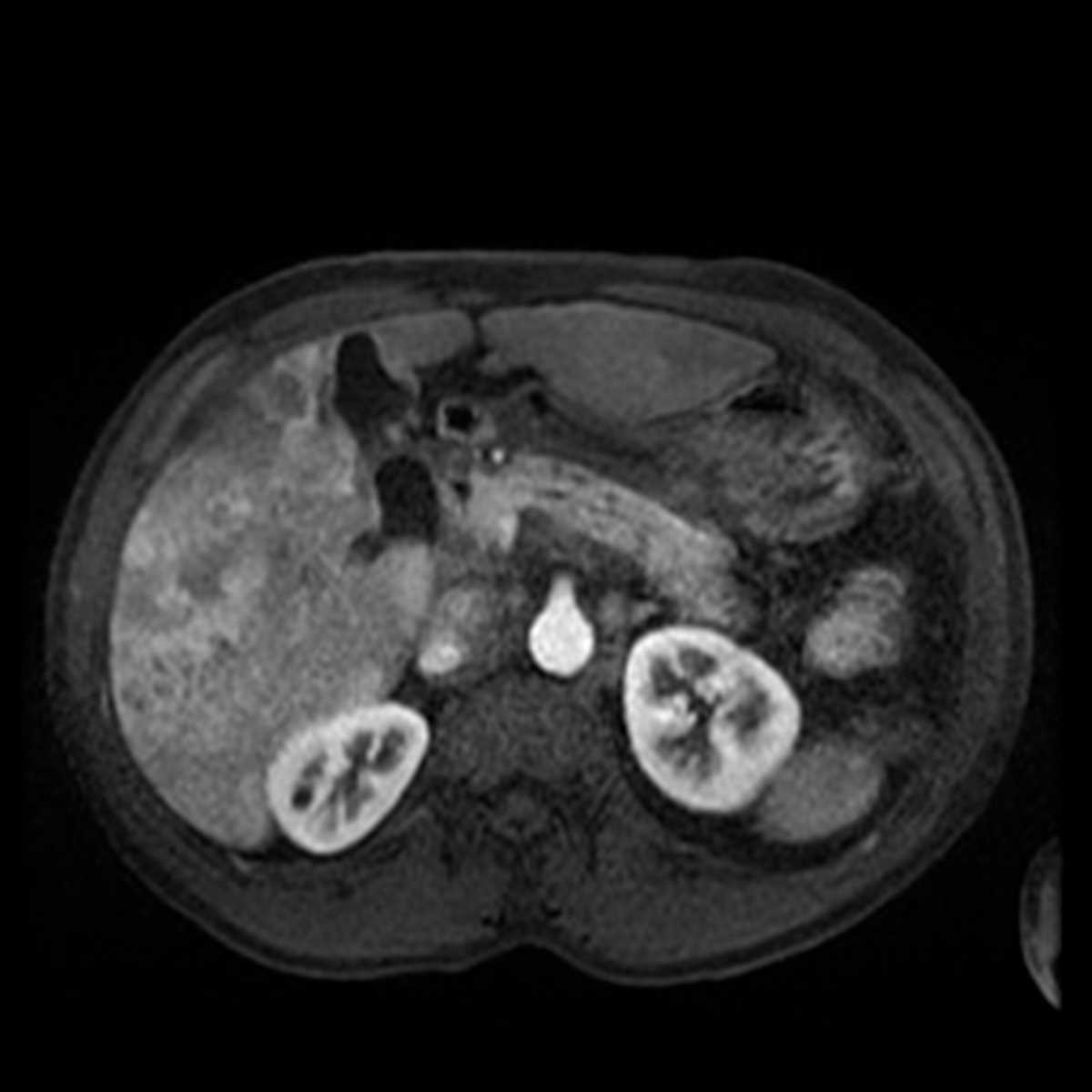 Multifocal Hepatocellular Carcinoma (Hepatoma) - CTisus CT Scan