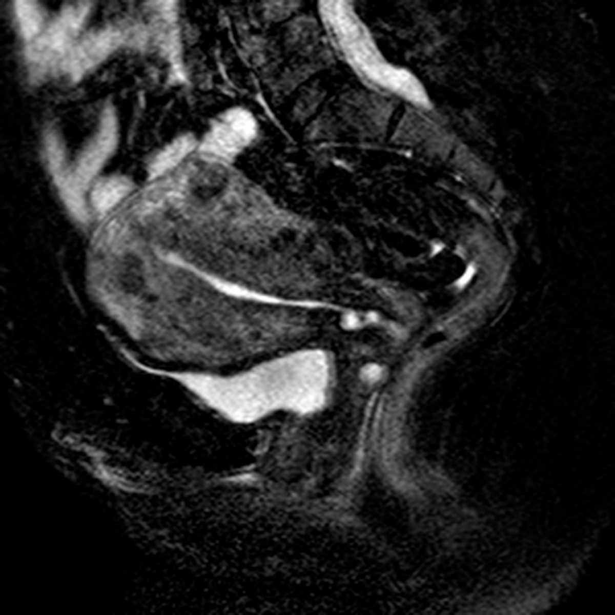 Adenomyosis - CTisus CT Scan