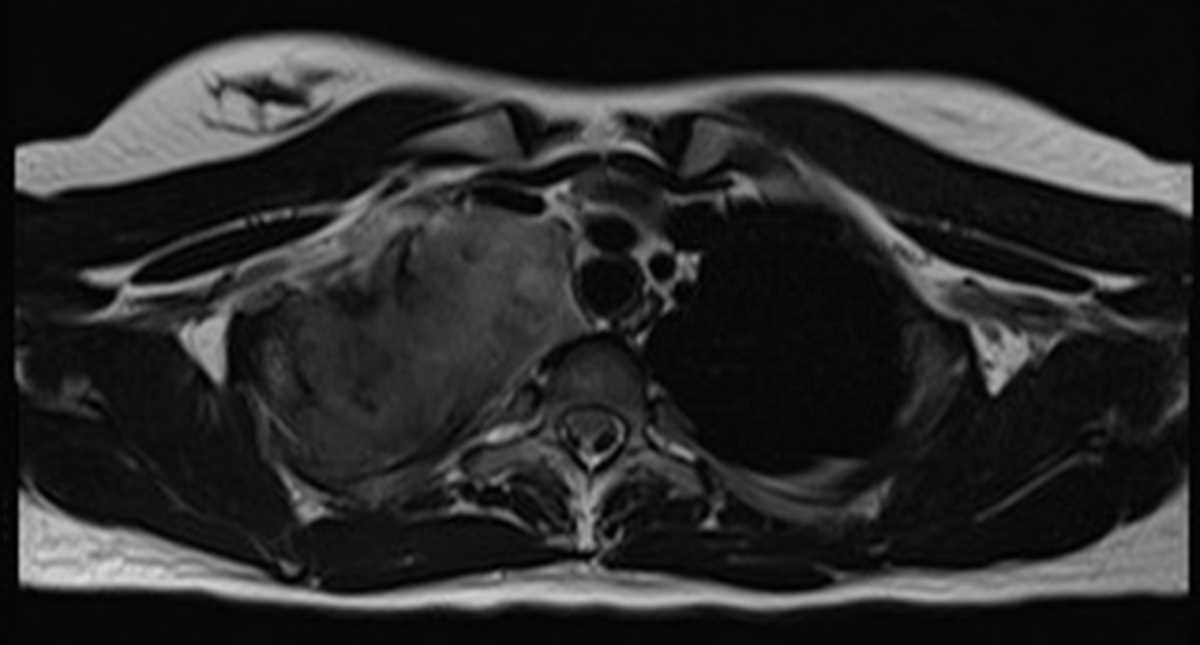 Chest wall desmoid tumor - CTisus CT Scan
