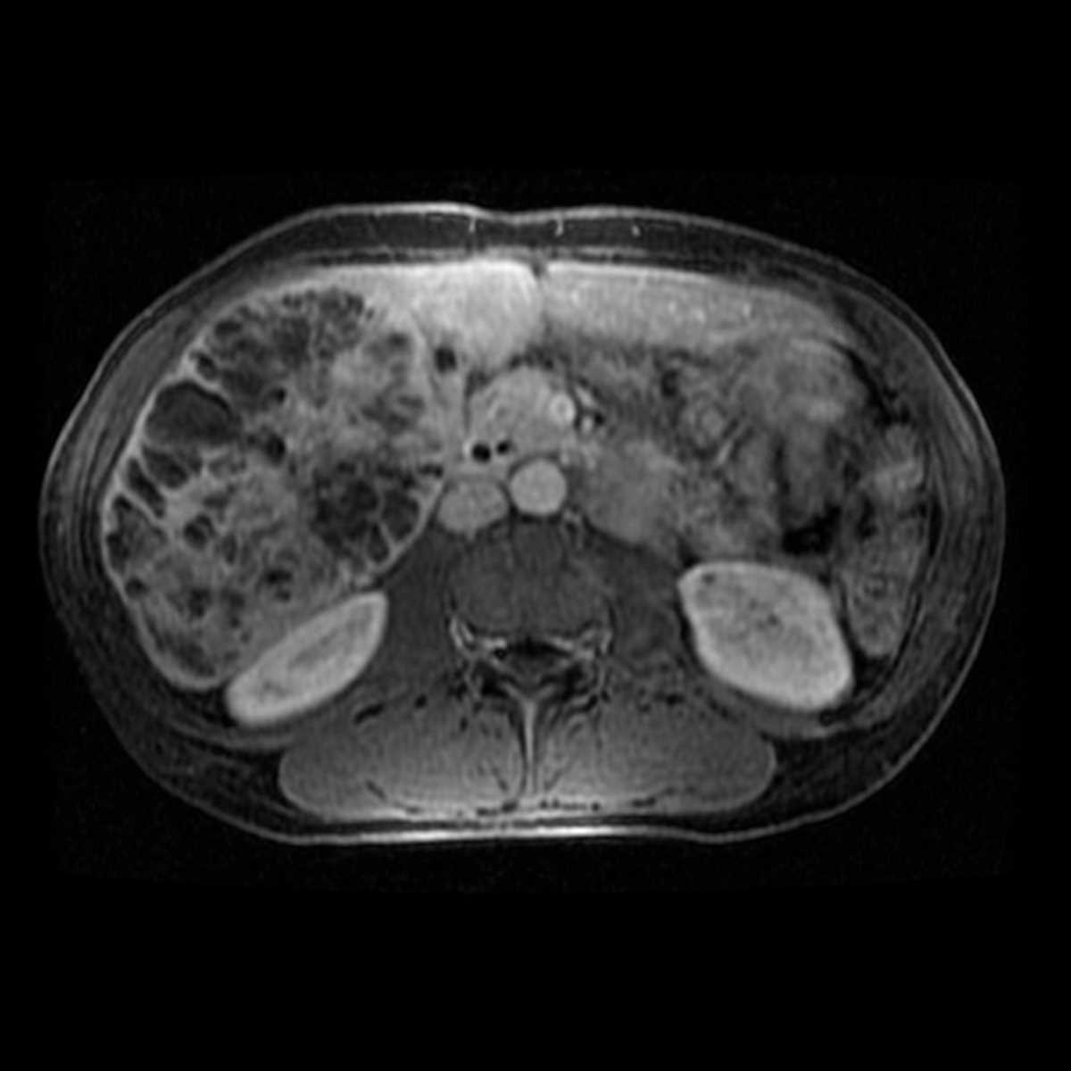 Metastatic carcinoid tumor to the liver - CTisus CT Scan