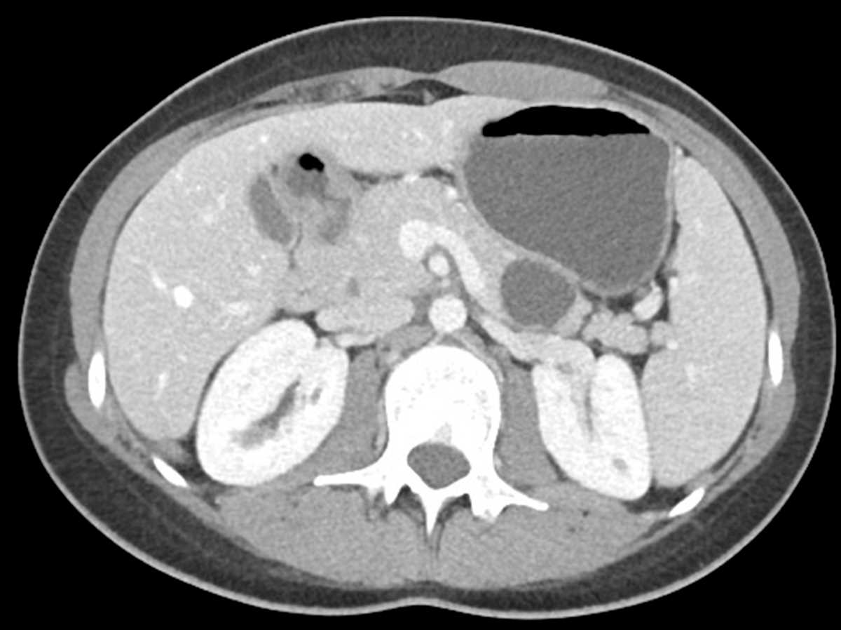 Mucinous cystic neoplasm of the pancreas - CTisus CT Scan