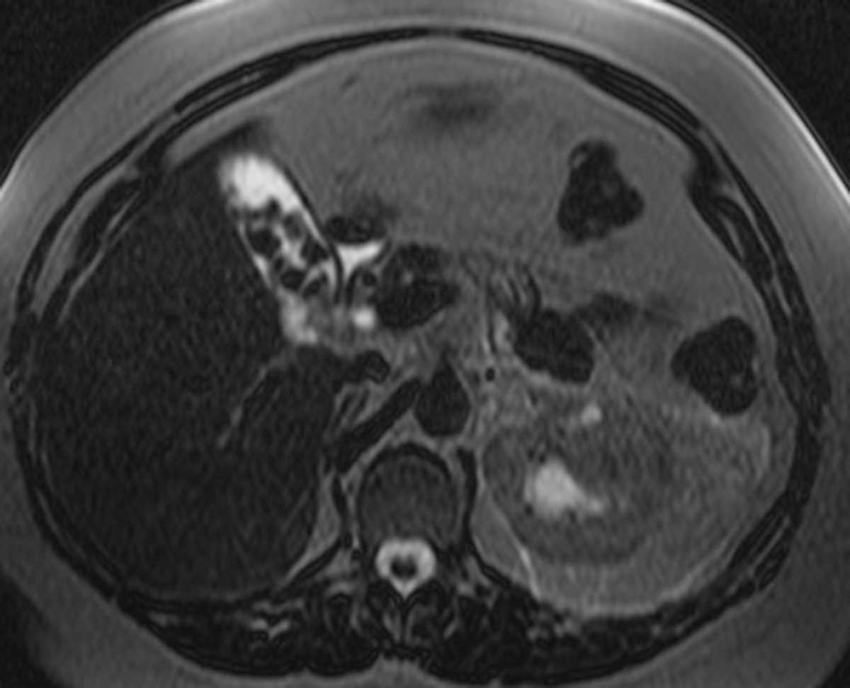 Cholelithiasis - CTisus CT Scan
