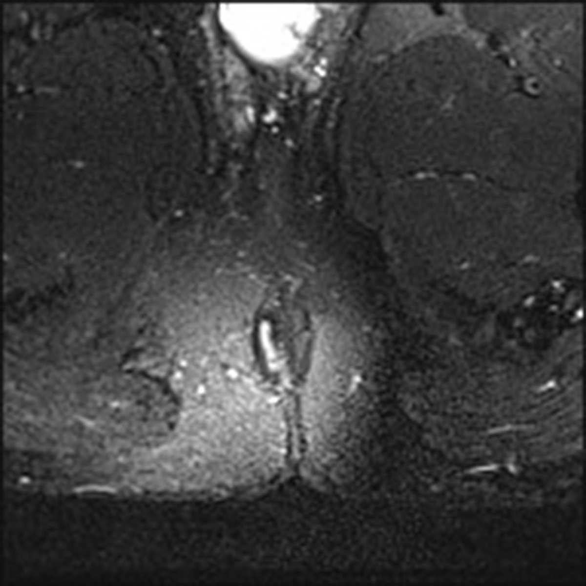 Transsphincteric perianal fistula - CTisus CT Scan