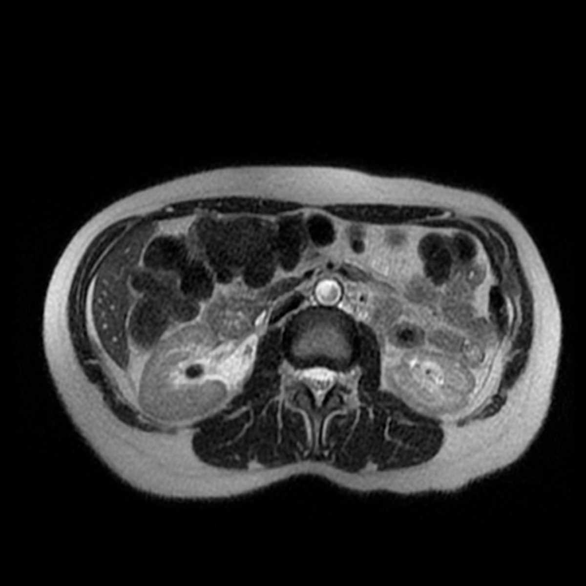 Renal Stones - CTisus CT Scan