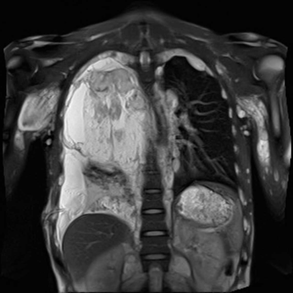 Malignant peripheral nerve sheath tumor in NF-1 - CTisus CT Scan