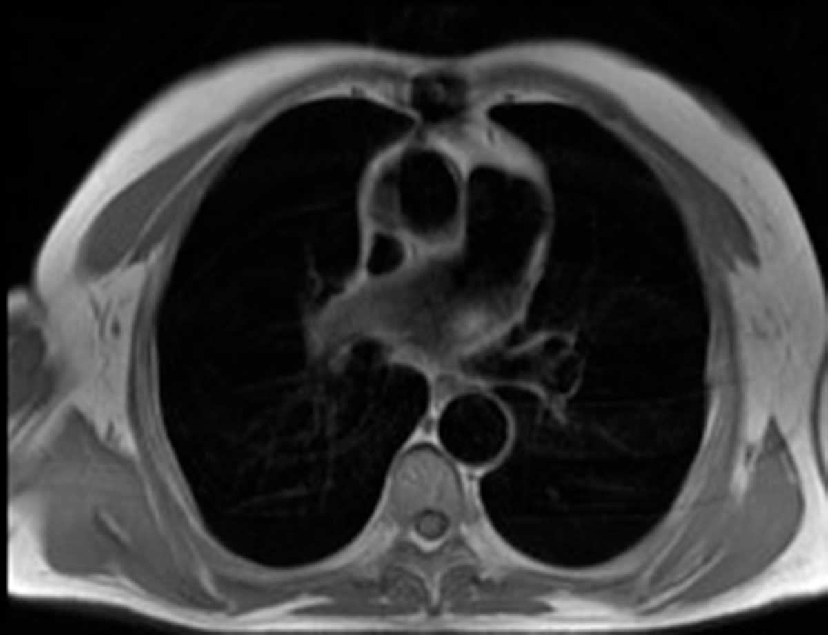 Ascending aortic pseudoaneurysm after graft repair - CTisus CT Scan