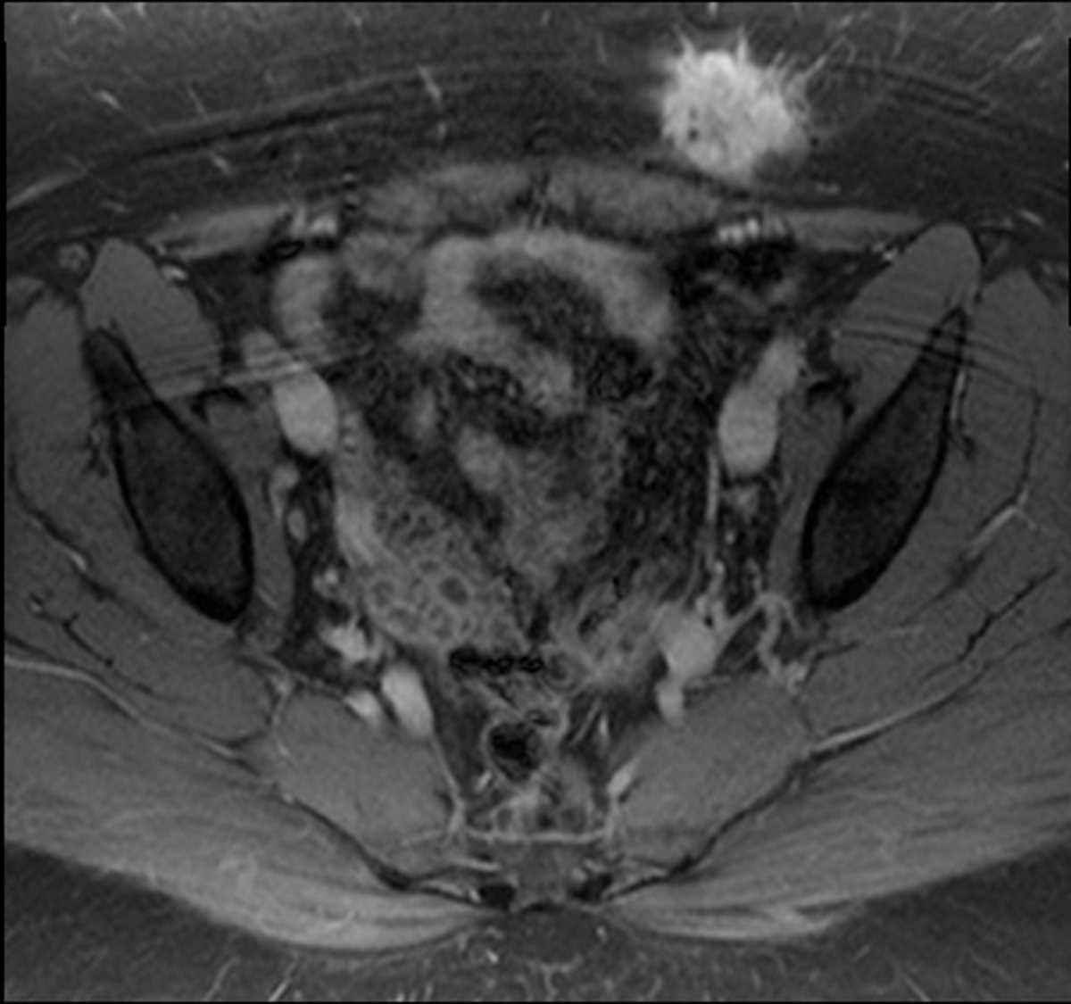 C-section scar endometriosis - CTisus CT Scan