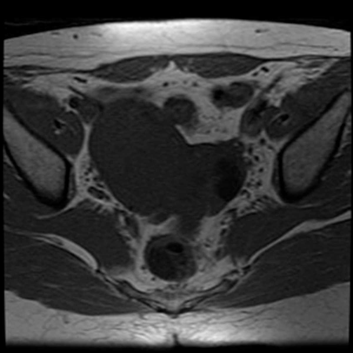 Uterine fibroid before and after uterine artery embolization - CTisus CT Scan