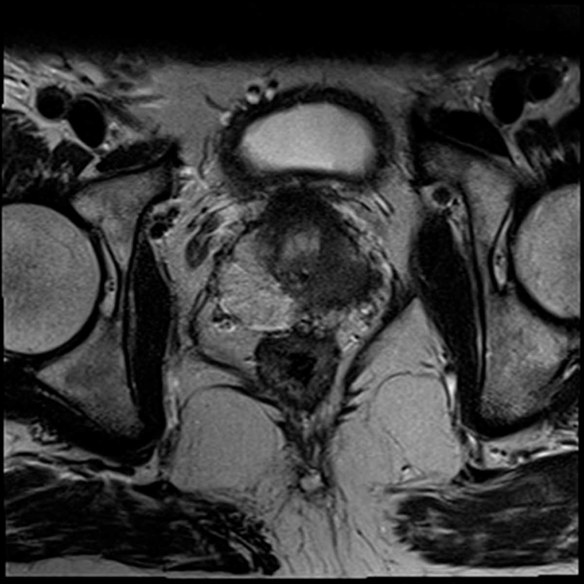 Prostate cancer with extracapsular extension - CTisus CT Scan