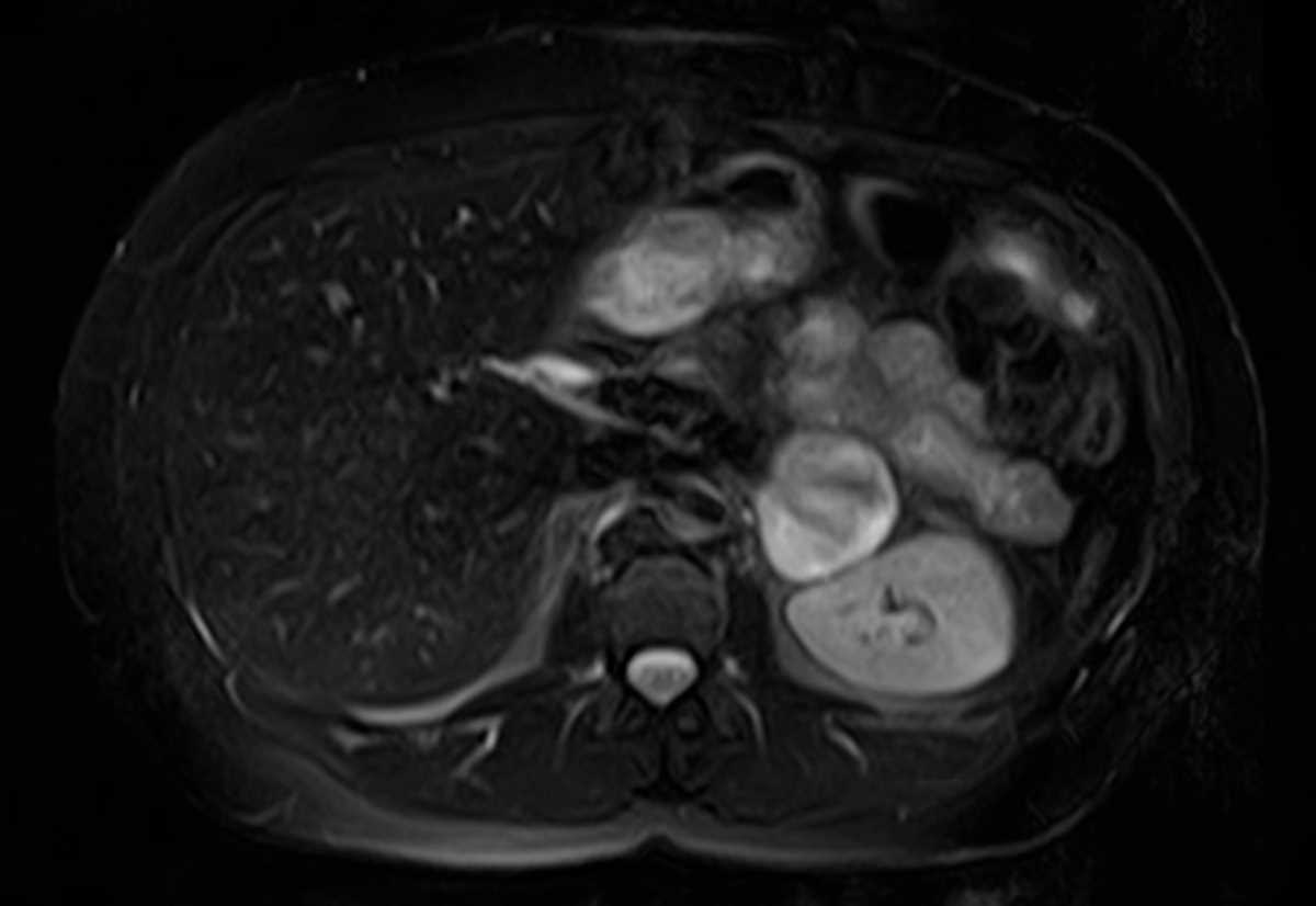 Adrenal pheochromocytoma - CTisus CT Scan