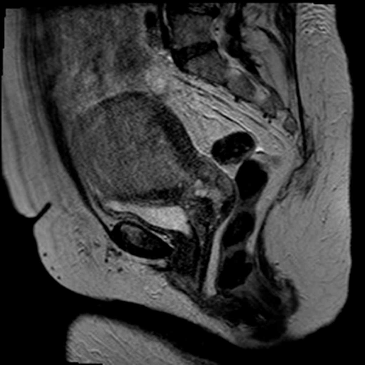 Endometrial cancer - CTisus CT Scan