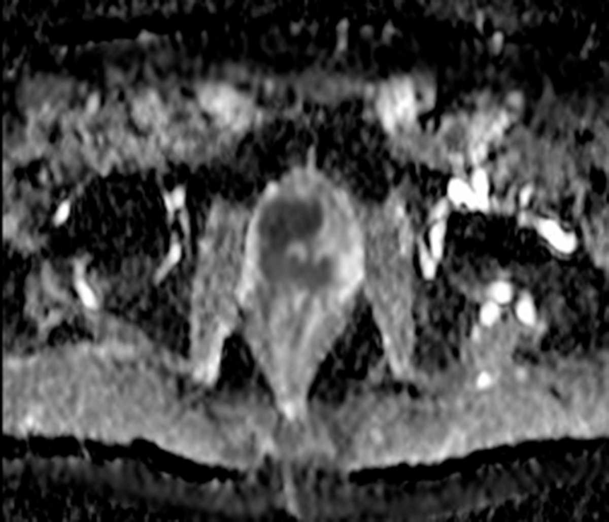 Prostate cancer - CTisus CT Scan