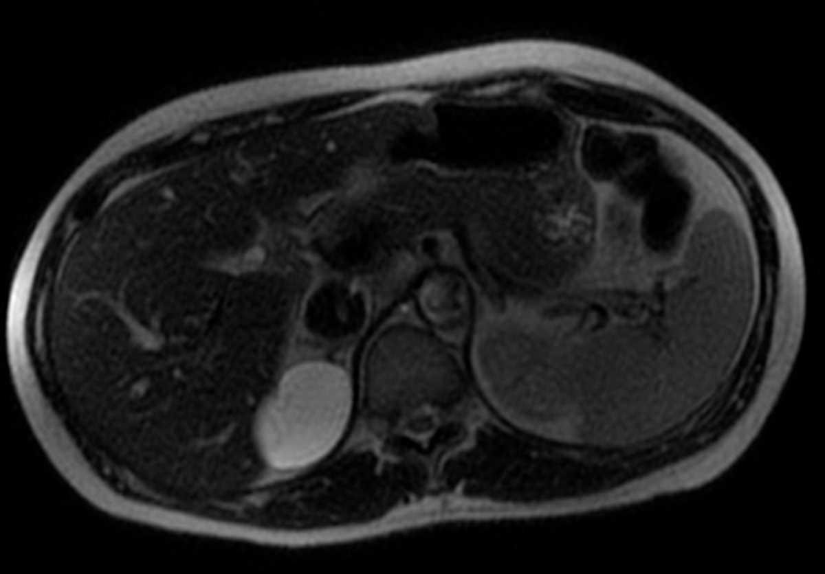 Adrenal cyst - CTisus CT Scan
