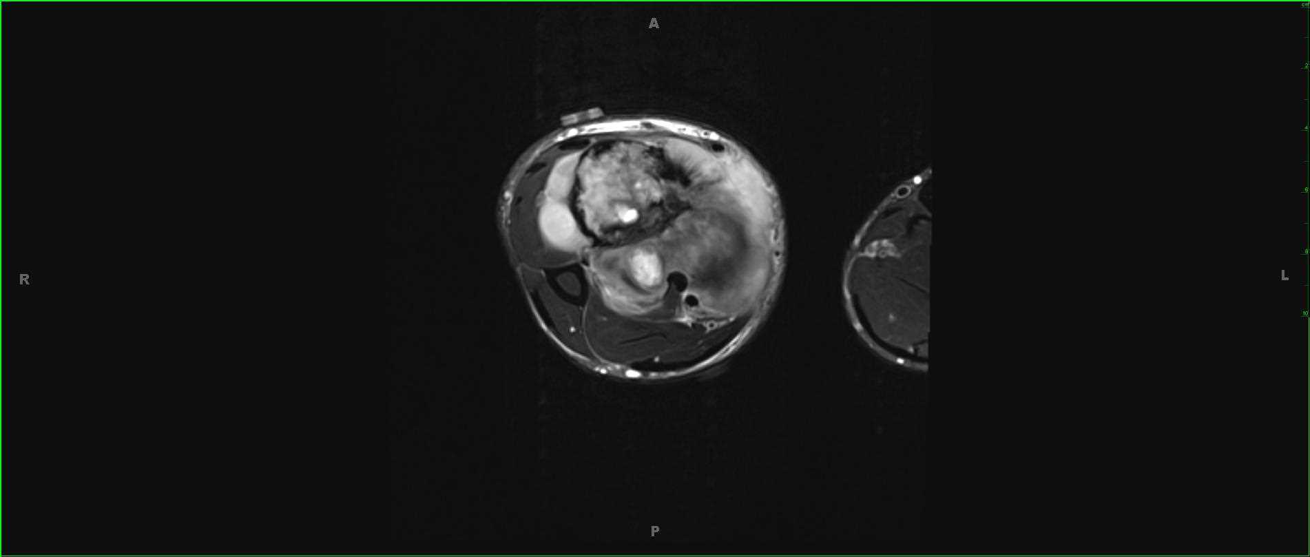 Fibrosarcoma - CTisus CT Scan