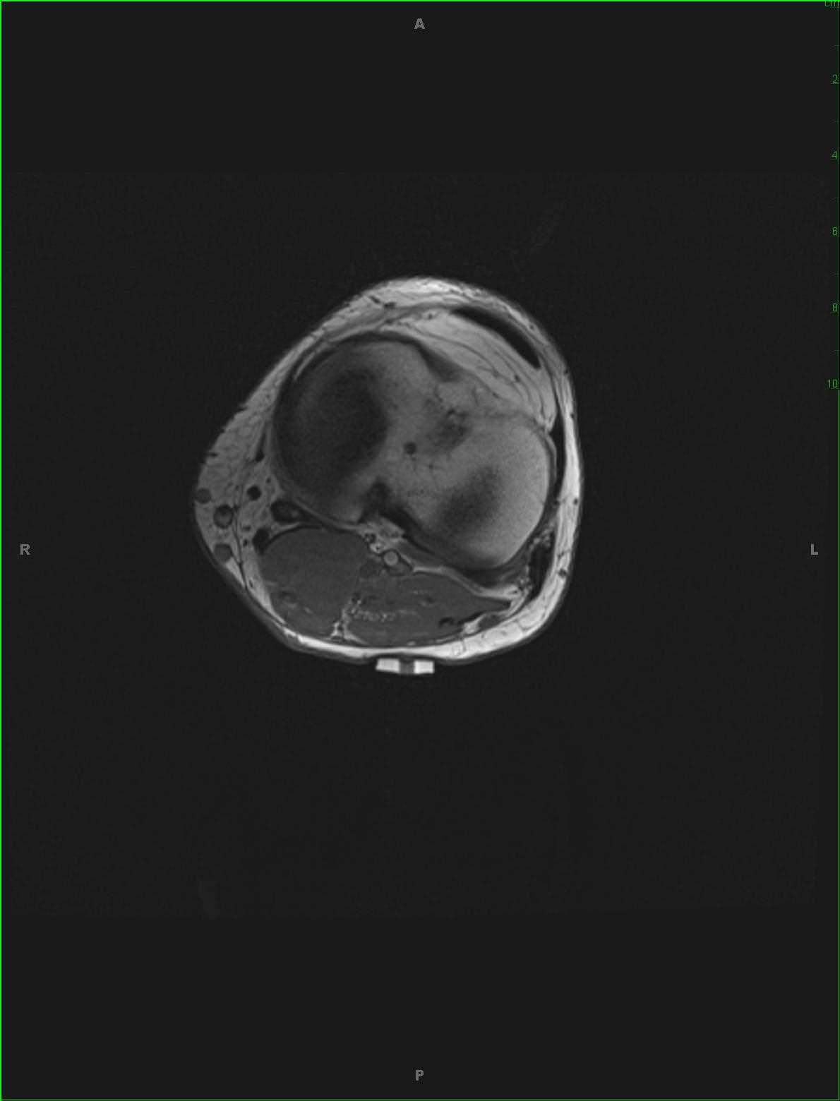 Common Peroneal Neuroma - CTisus CT Scan