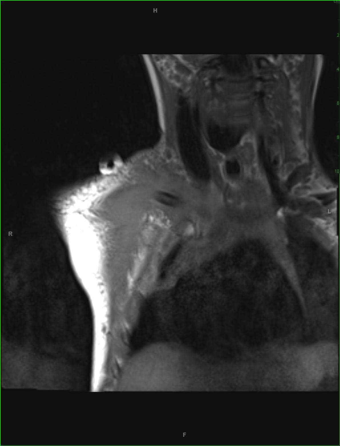 Right Clavicle Osteomyelitis and Subperiosteal Abscess - CTisus CT Scan