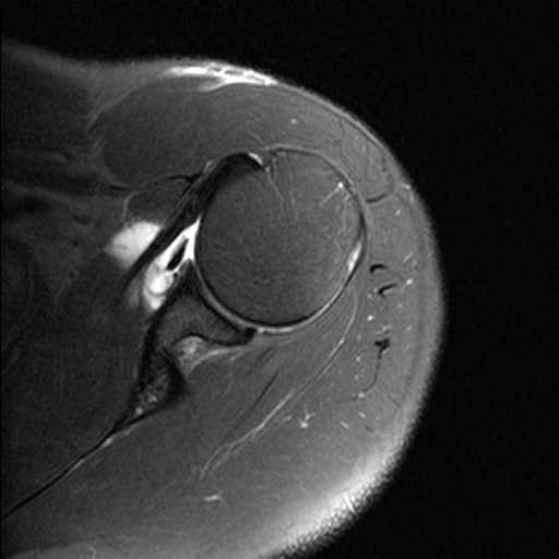 Type 2 SLAP Tear - CTisus CT Scan