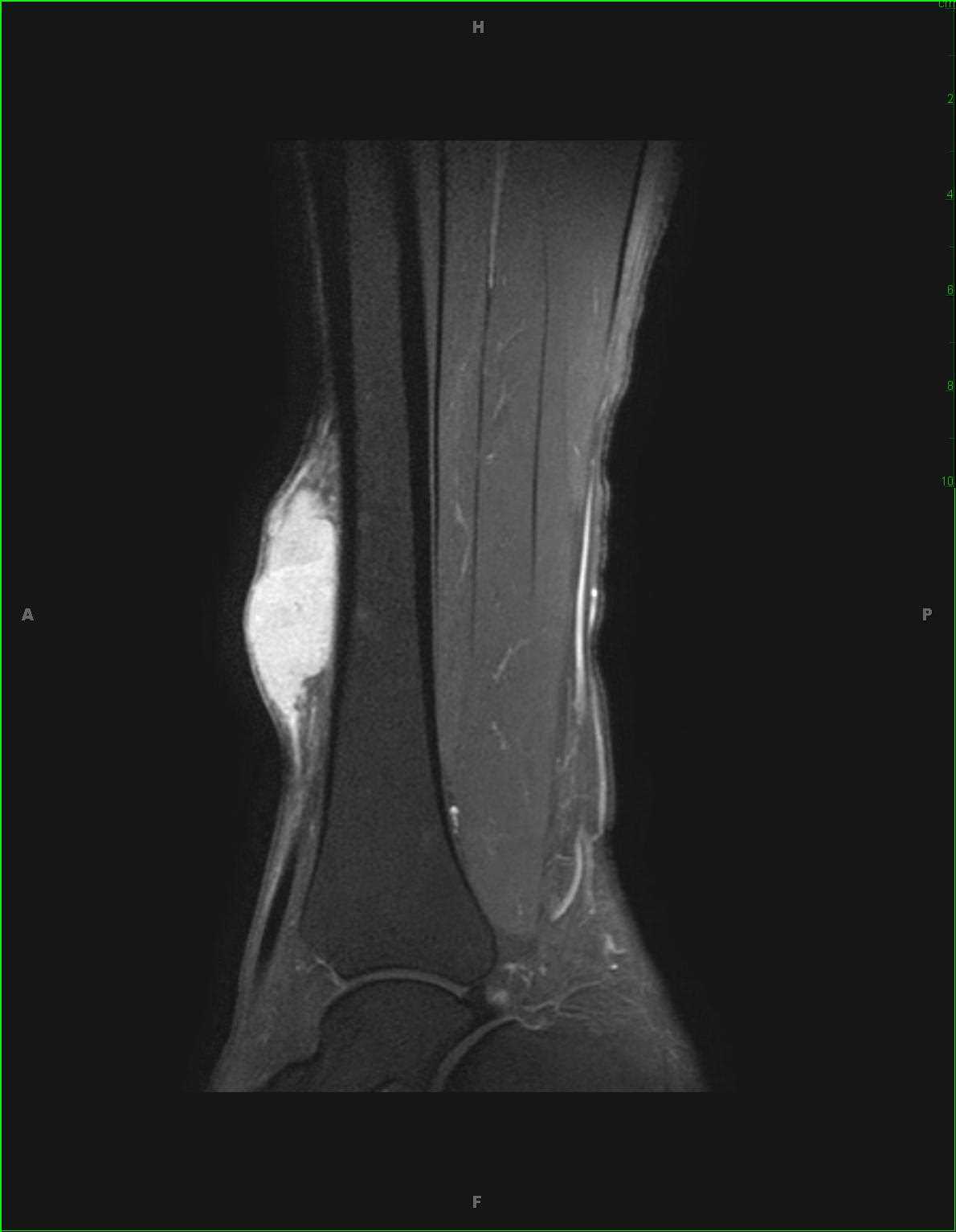 Spindle Cell Sarcoma, Leg - CTisus CT Scan