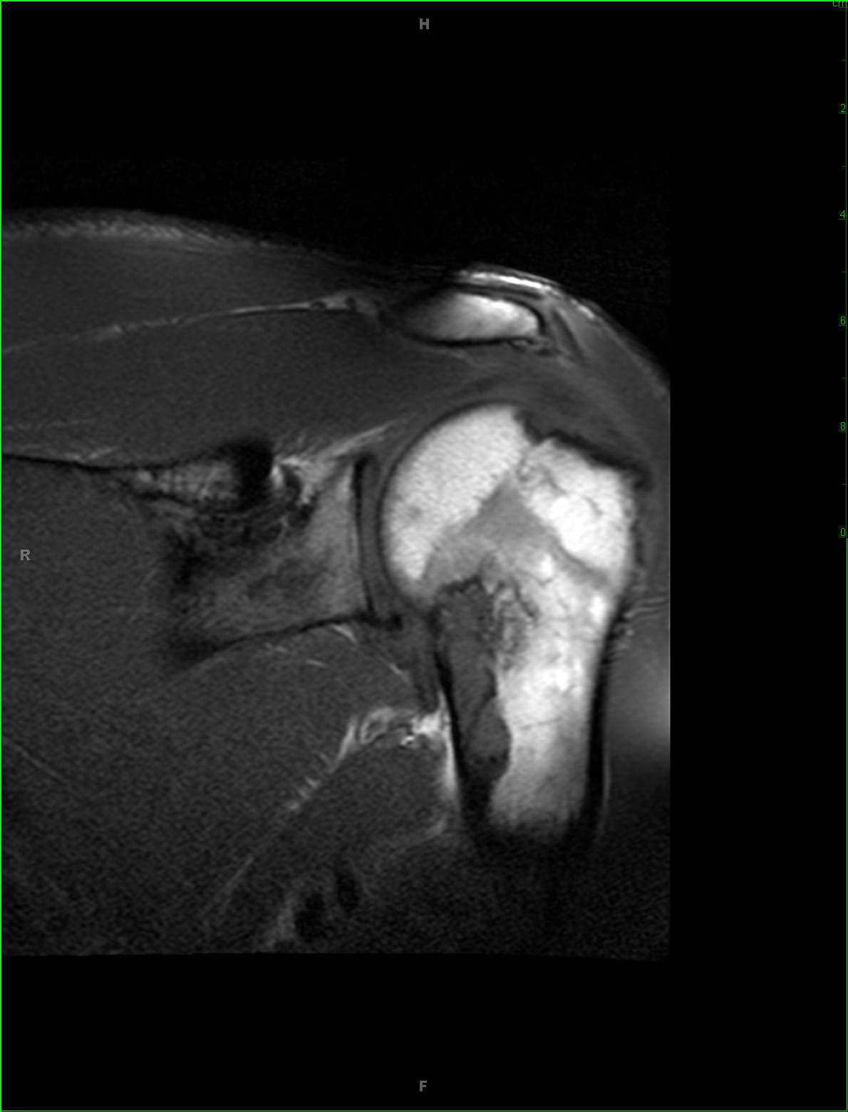 Polyostotic Fibrous Dysplasia - CTisus CT Scan