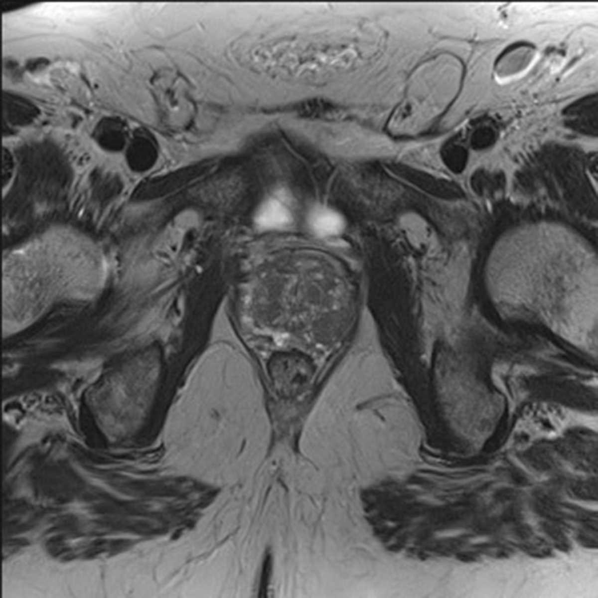 Gleason 8 Prostate Cancer - CTisus CT Scan
