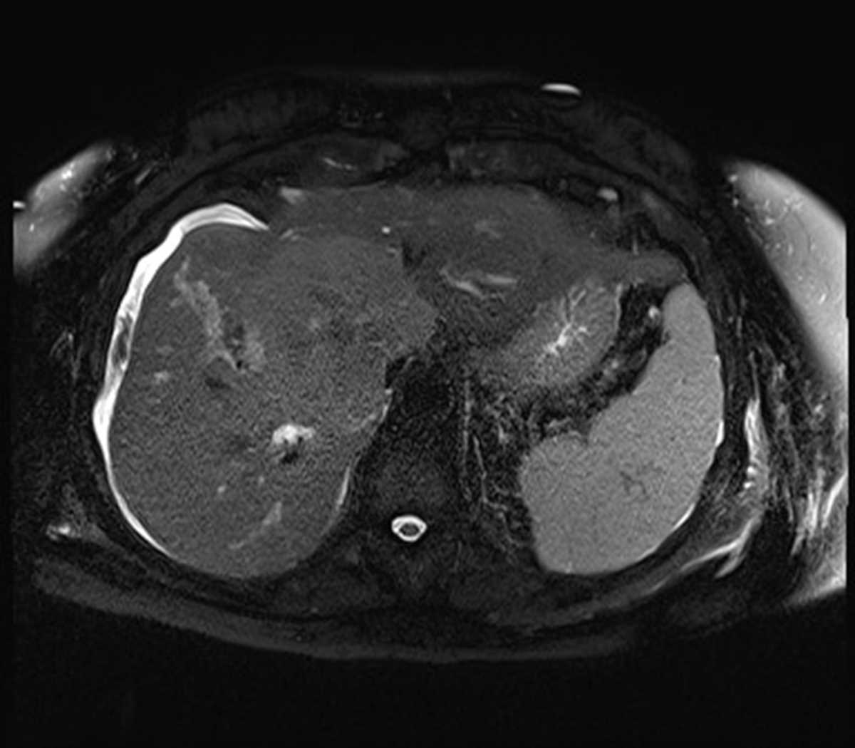 Hepatic Cholangiocarcinoma - CTisus CT Scan