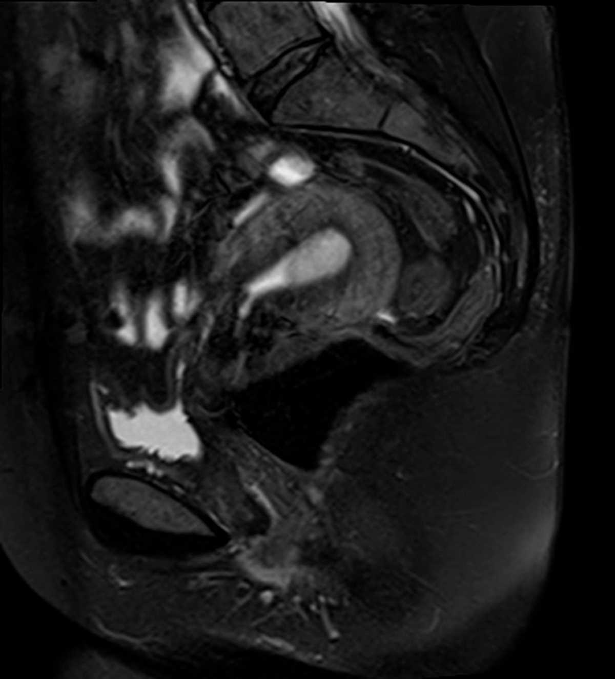 Endometrial Polyp - CTisus CT Scan