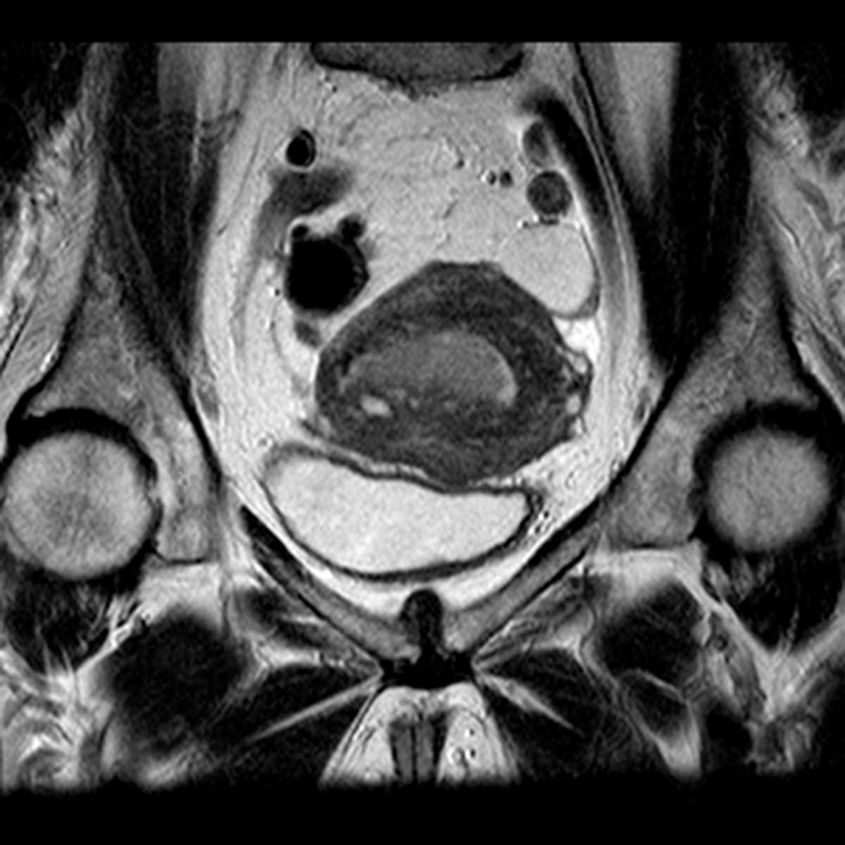 Endometrial Cancer with < 50% myometrial invasion - CTisus CT Scan