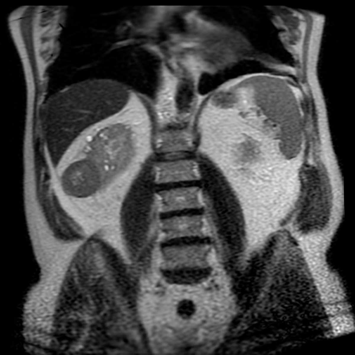 Chromophobe Renal Cell Carcinoma (RCC) - CTisus CT Scan