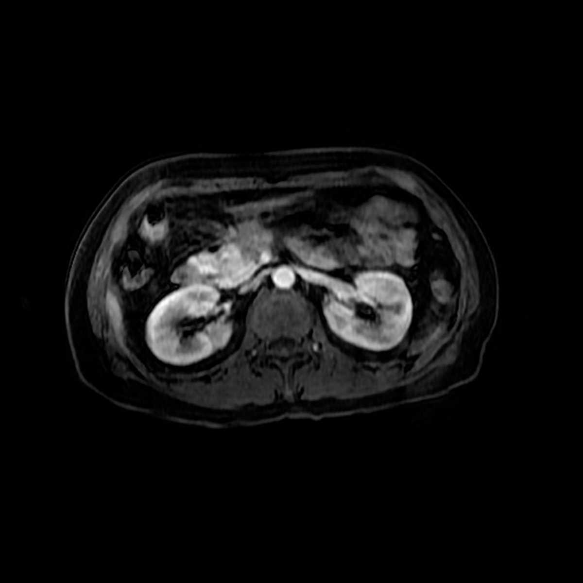 Pancreatic Adenocarcinoma - CTisus CT Scan