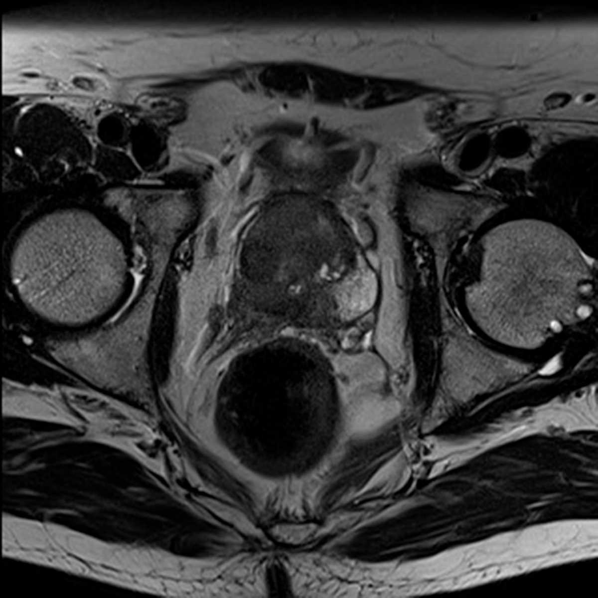 Prostate Cancer - CTisus CT Scan