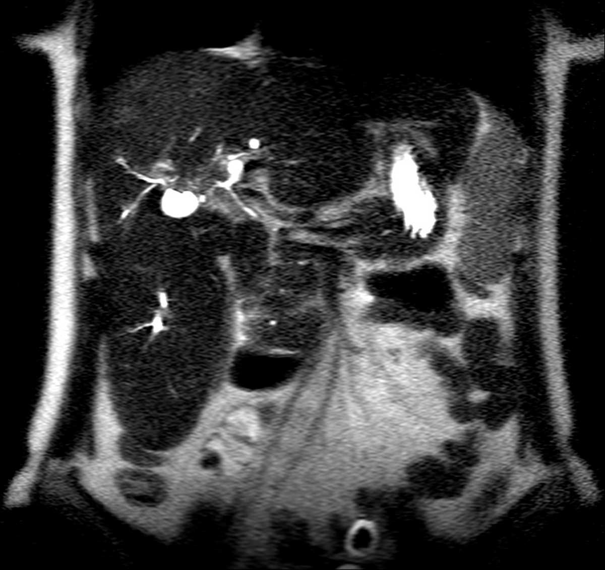 Hilar Cholangiocarcinoma - CTisus CT Scan
