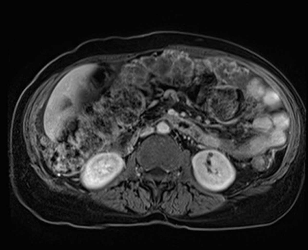 Peritoneal carcinomatosis - CTisus CT Scan