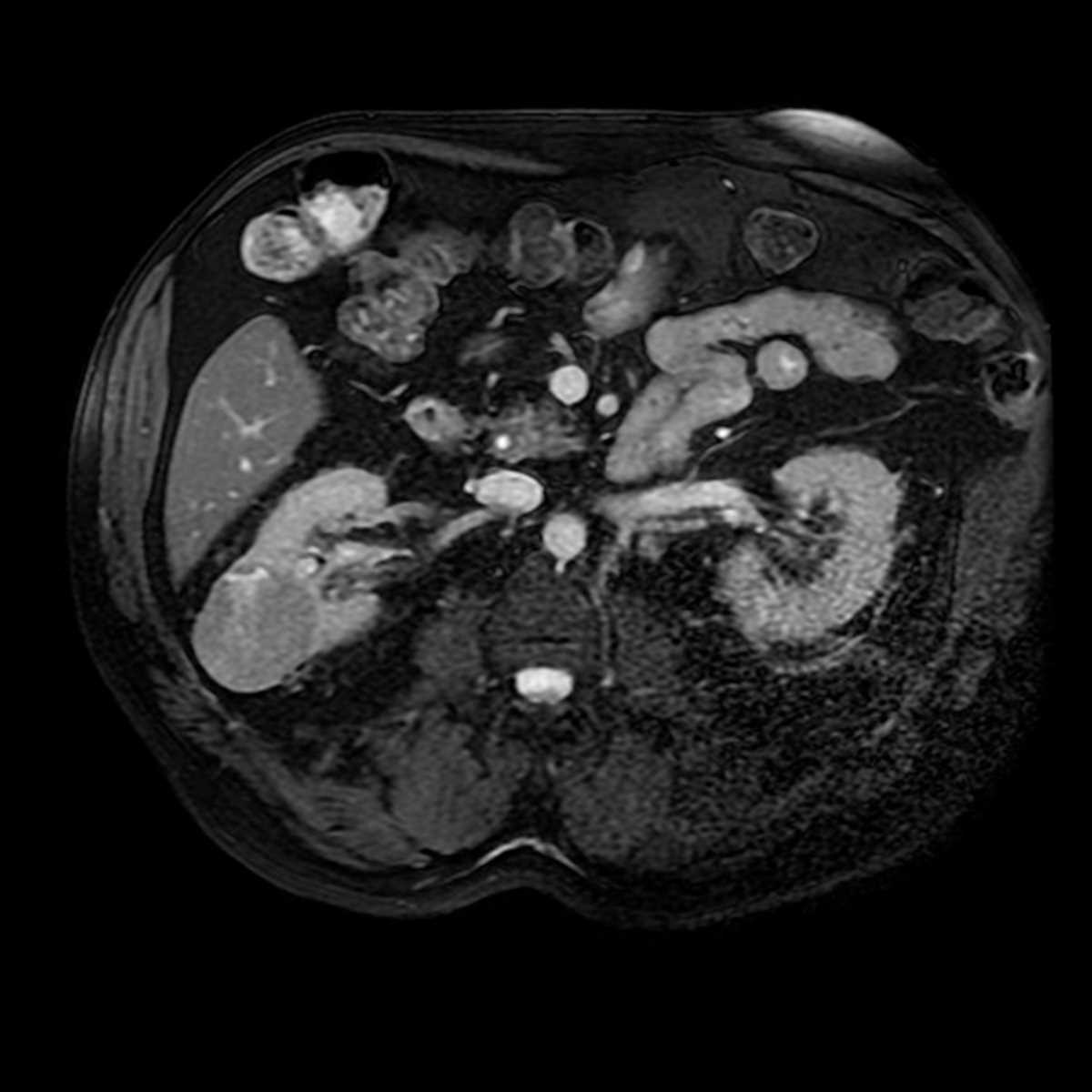 Chromophobe Renal Cell Carcinoma (RCC) - CTisus CT Scan