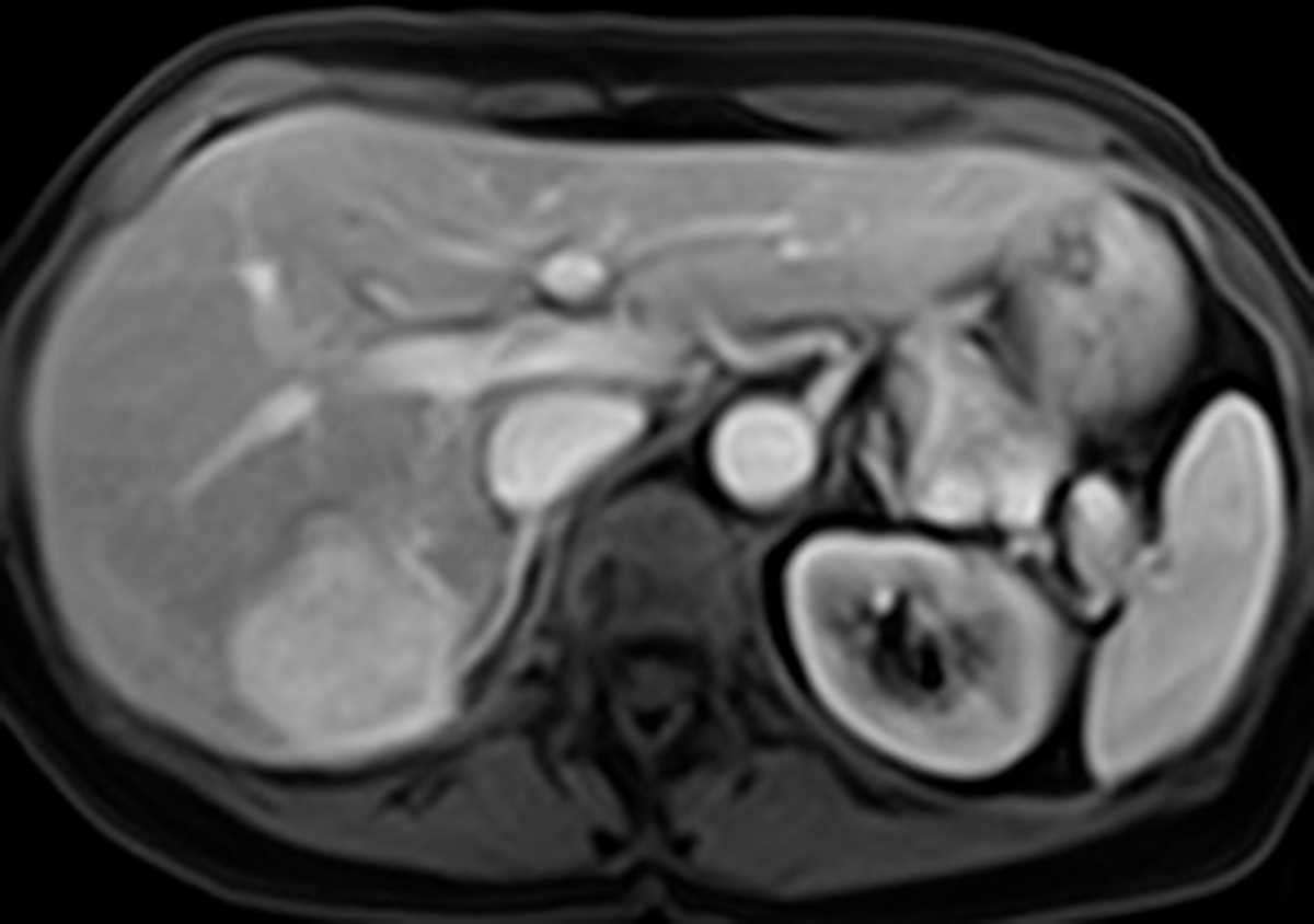 Focal Nodular Hyperplasia (FNH) - CTisus CT Scan