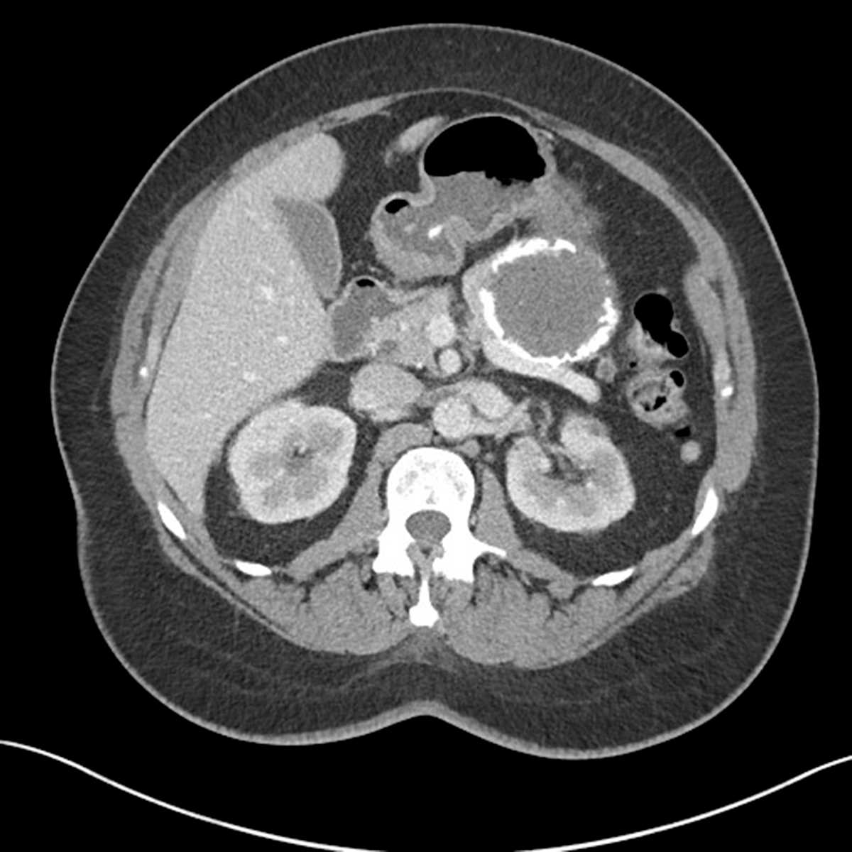 Pseudocyst - CTisus CT Scan