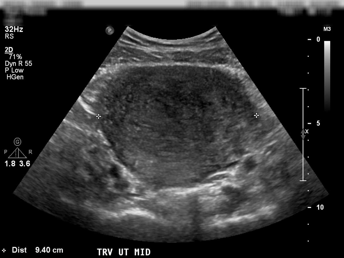 Uterine Adenomyosis - CTisus CT Scan