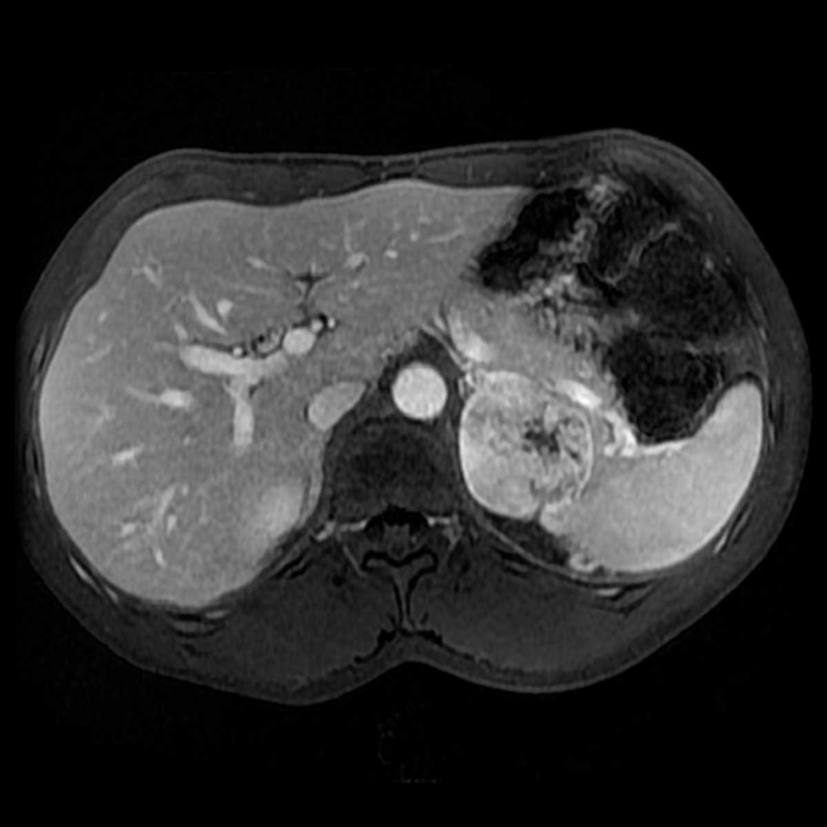 Pheochromocytoma - CTisus CT Scan