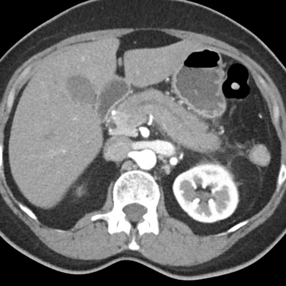 Autoimmune pancreatitis - CTisus CT Scan