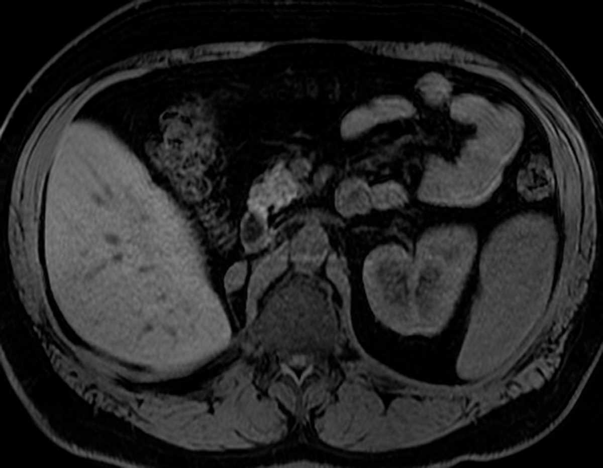 Renal cell carcinoma metastasis to adrenal - CTisus CT Scan