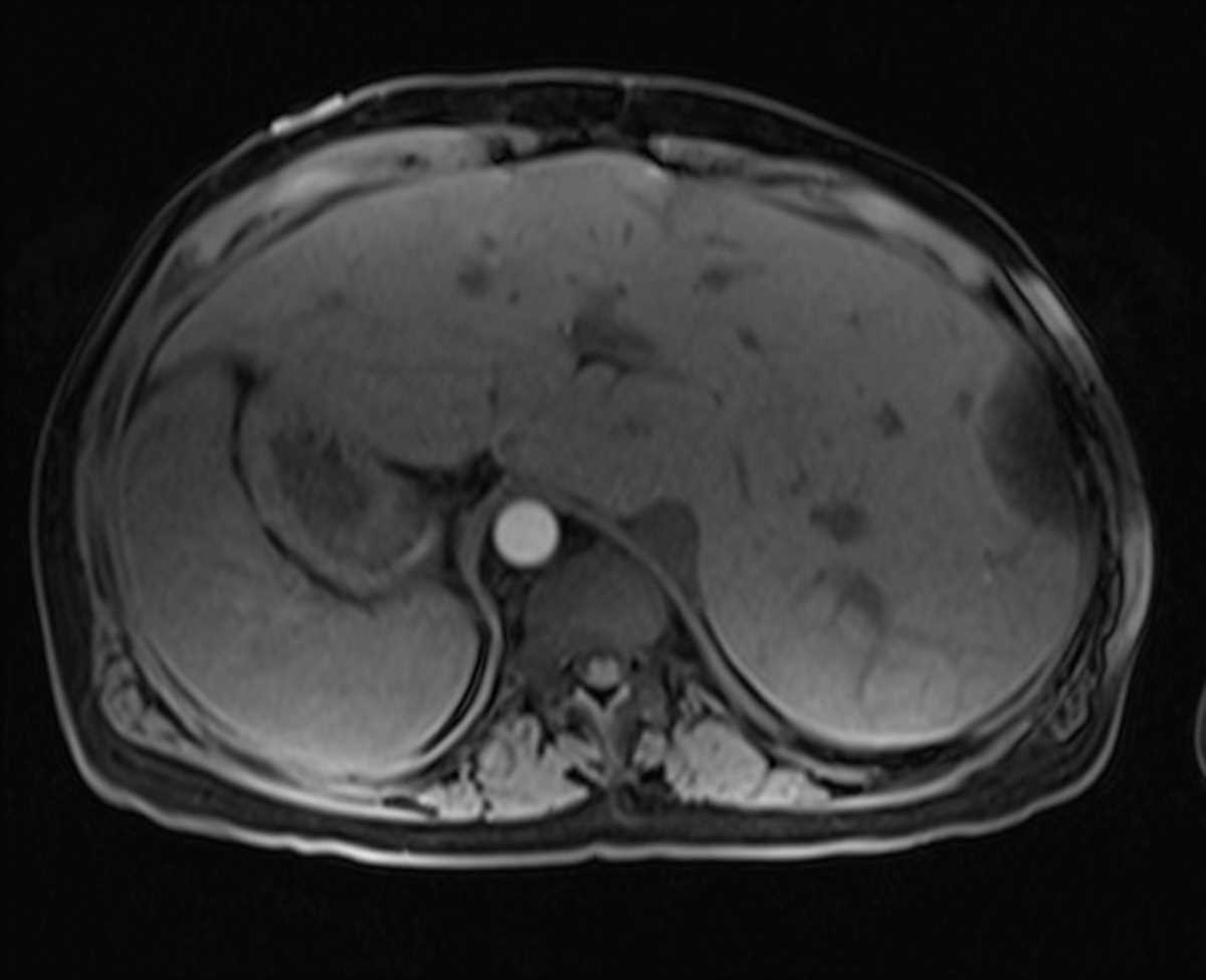Situs Inversus - CTisus CT Scan