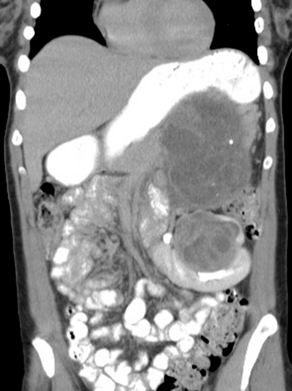Neurofibroma - CTisus CT Scan