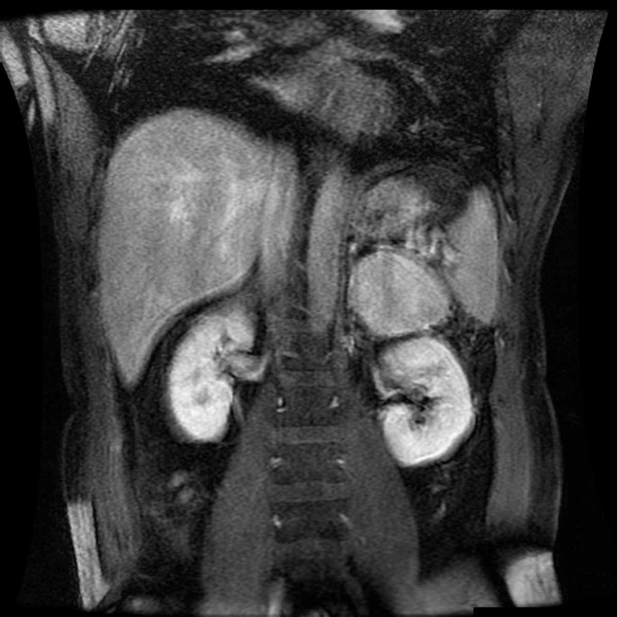 Paraganglioma - CTisus CT Scan