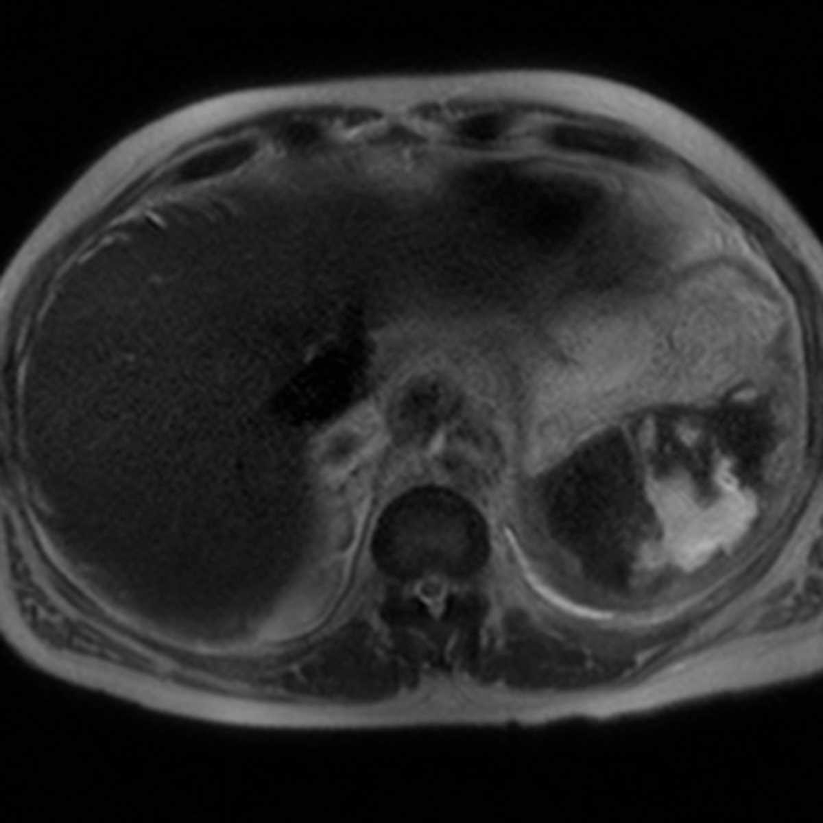 Hemorrhagic splenic infarct - CTisus CT Scan