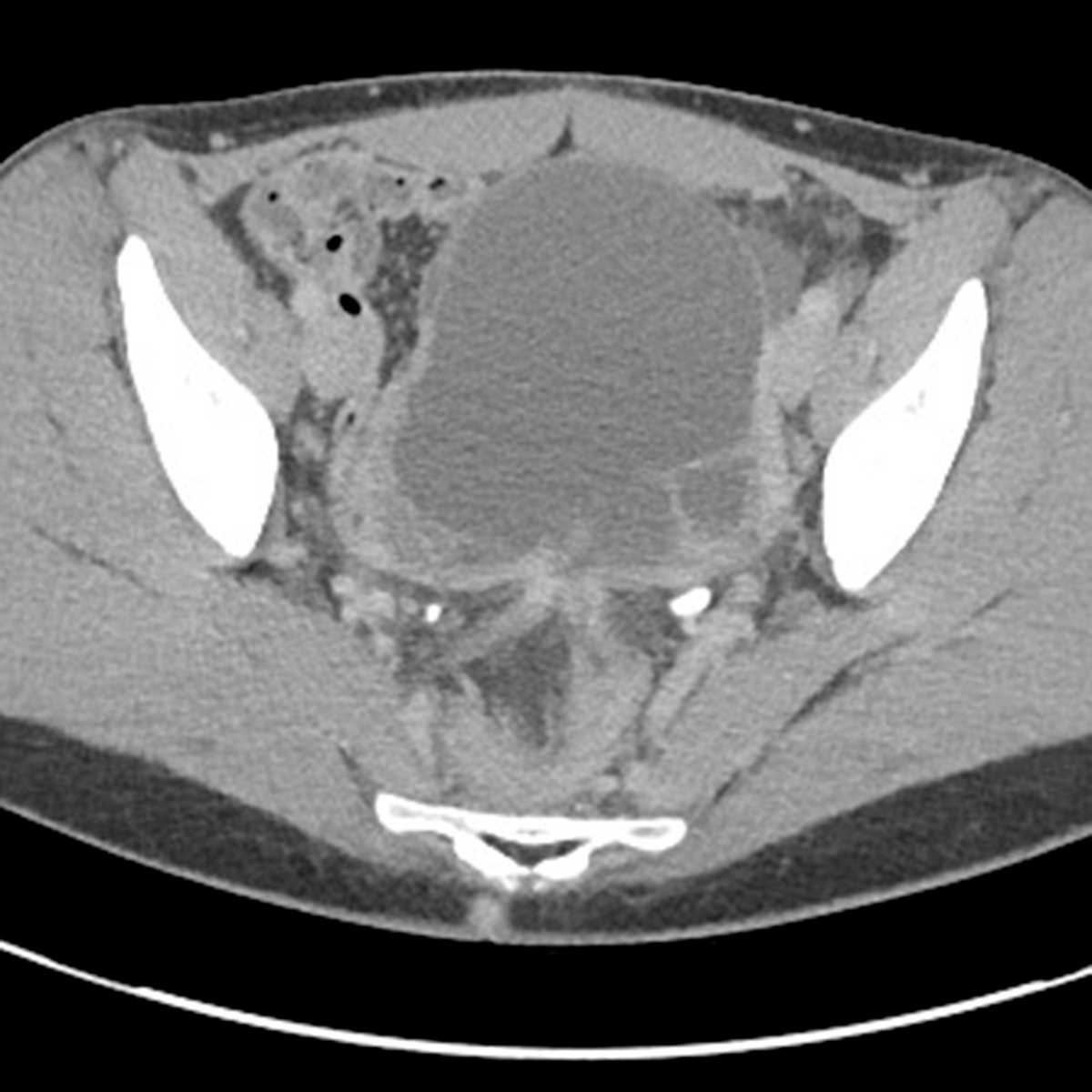 Endometriosis with hematosalpinx - CTisus CT Scan