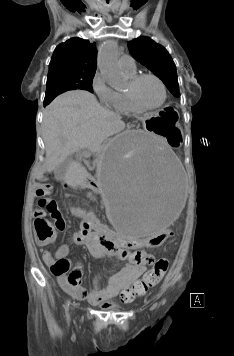 Echinococcal Cyst - CTisus CT Scan
