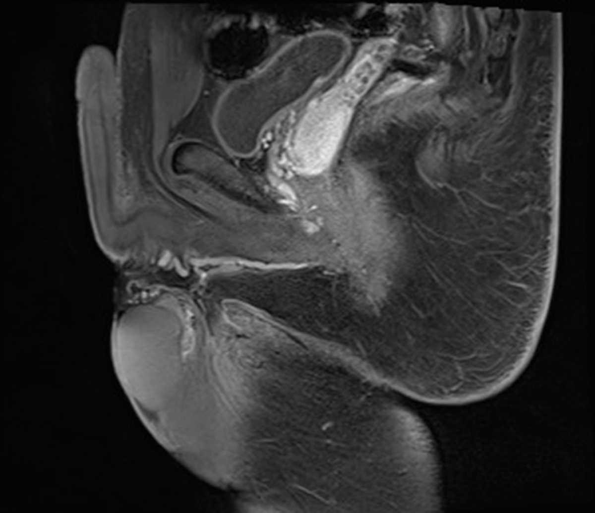 Penile Arteriovenous Malformation (AVM) - CTisus CT Scan